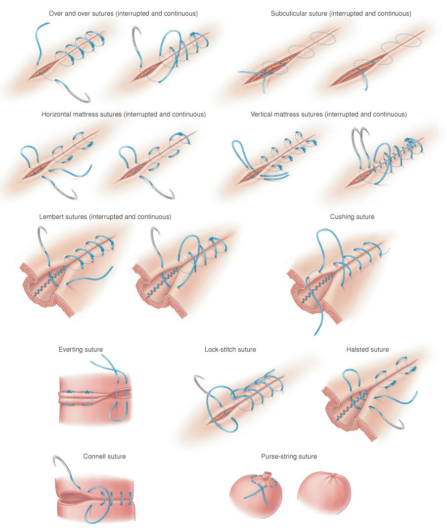 Interrupted mucosal or mucosal-submucosal suture pattern | Download  Scientific Diagram